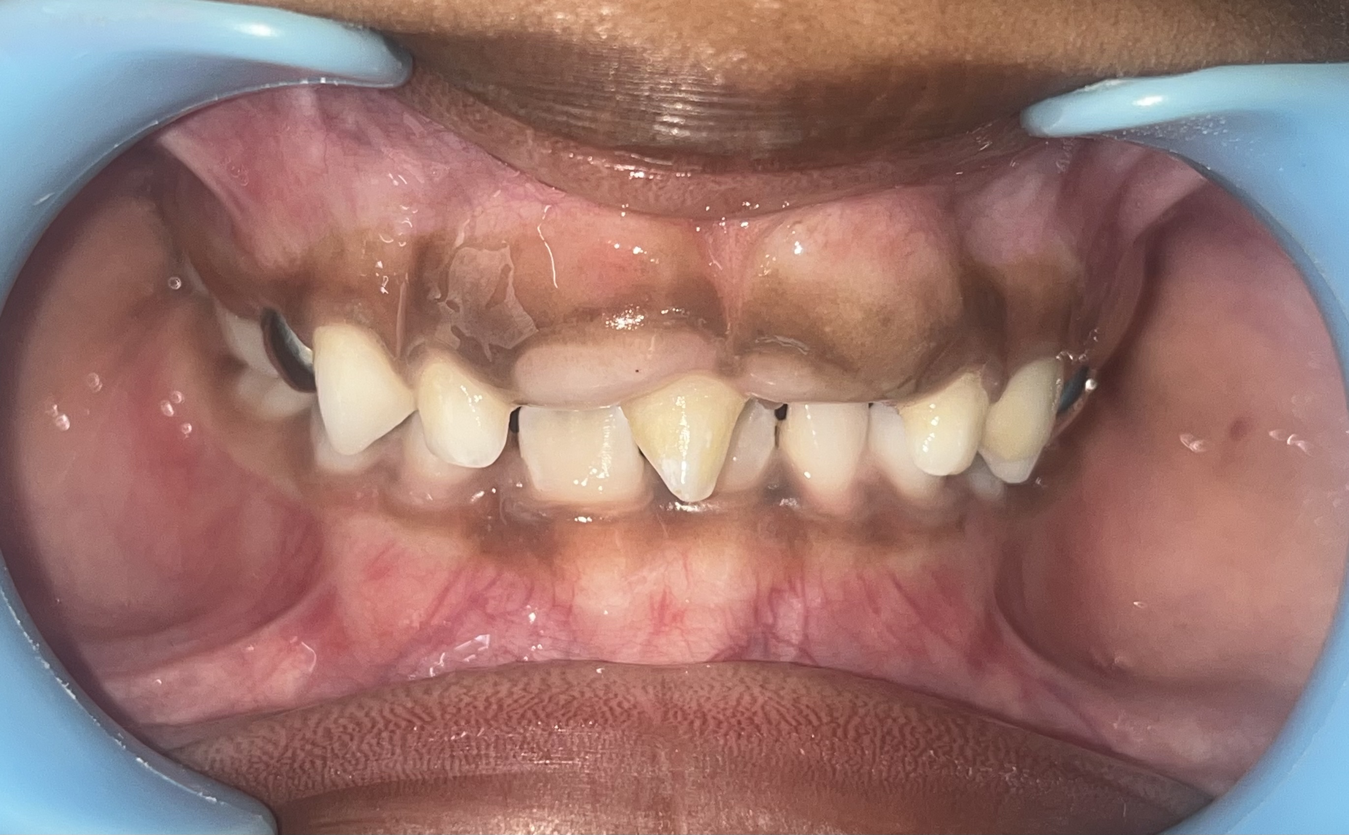 Dental Sealants