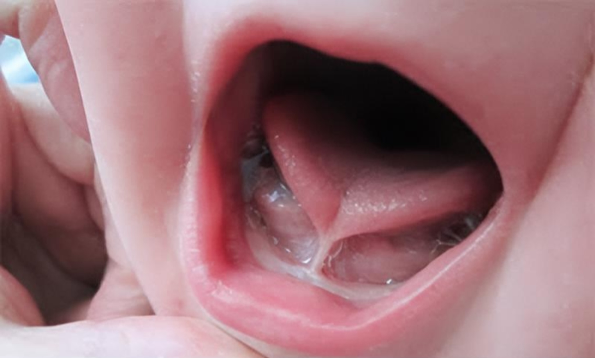 Dental Cleaning