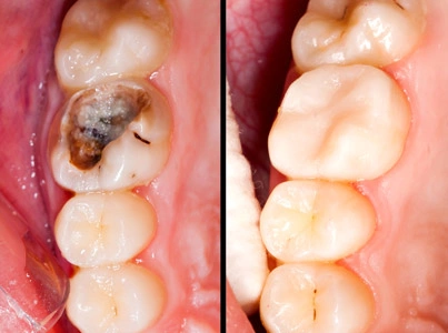 Dental Fillings Conservative Restorative Category Card