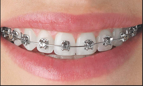 Adult Orthodontic Braces ceramic clear bracket system alignment tracking photo