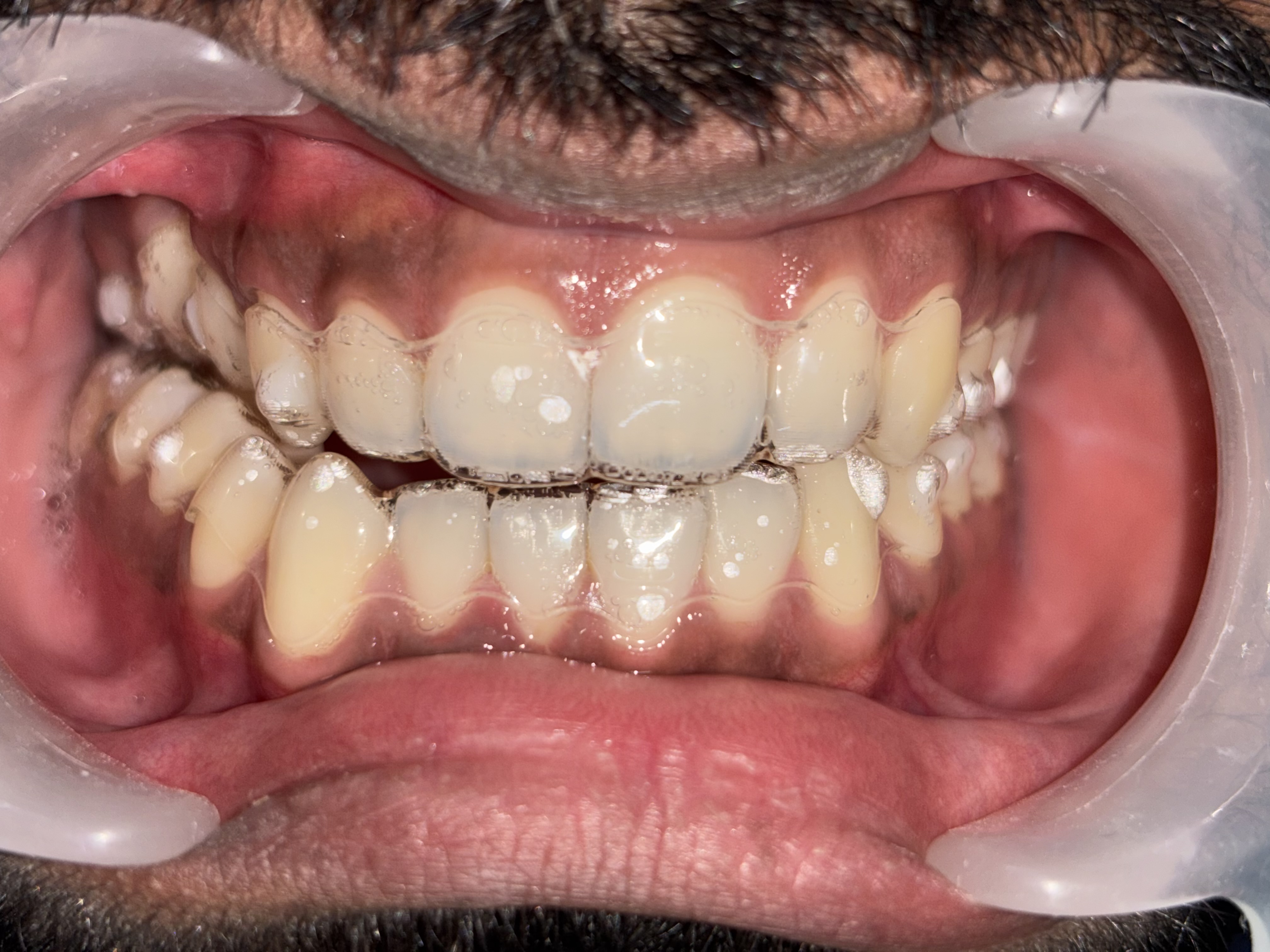 Adult Invisalign Custom Aligner 3D tracking software rendering layout profile