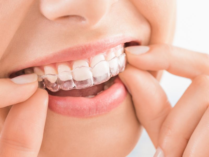 Invisalign Clear Aligners Category Card