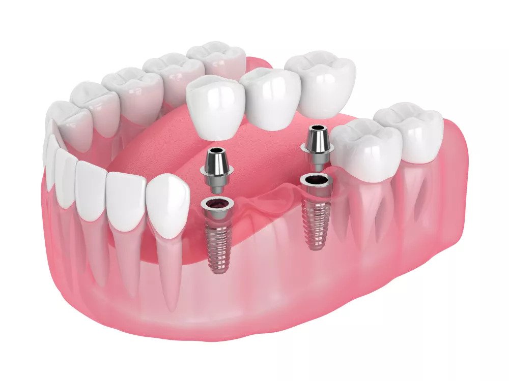 Full Arch hybrid Fixed titanium structure implant restorations photo