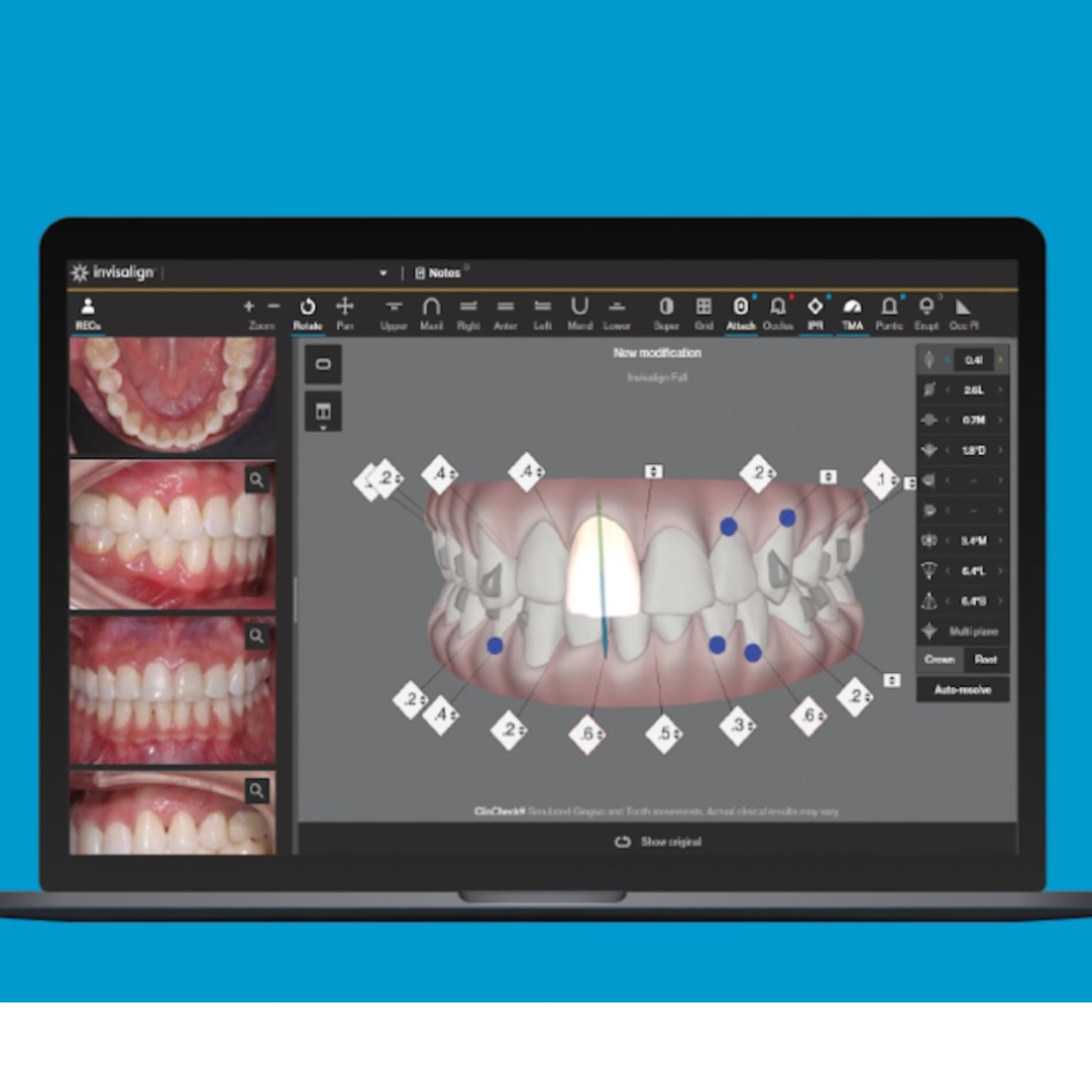 Invisalign for Teens specialized blue compliance tracking indicator dot macro action photo