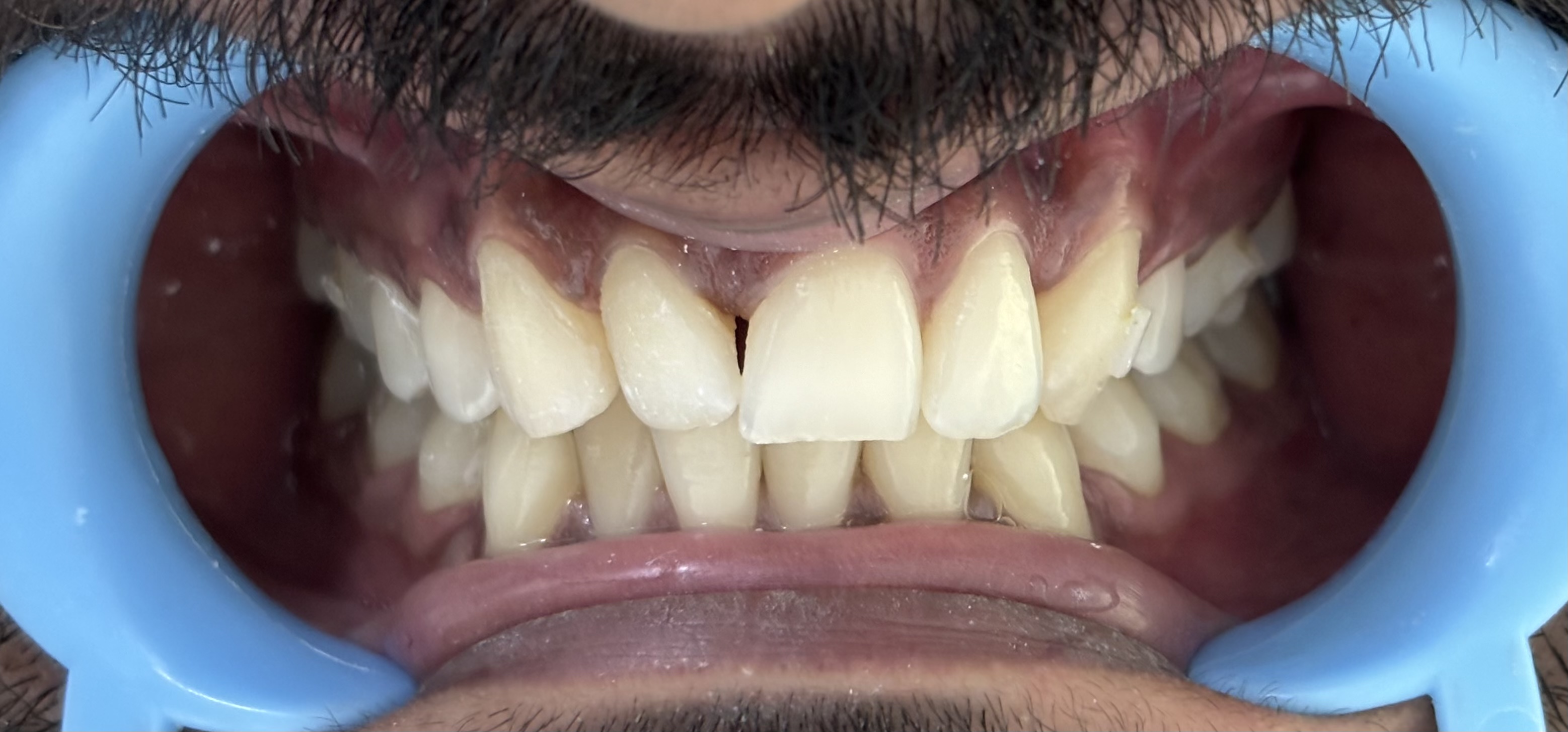 Before