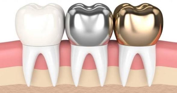 Dental Crowns Restorations Category Card
