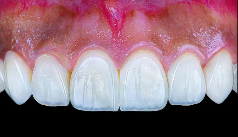 Direct Composite Resin multi-surface dental enamel hand sculpting procedure photo