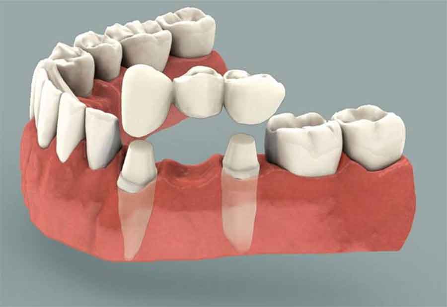 Traditional multi-unit porcelain fixed dental bridge preparation action view photo