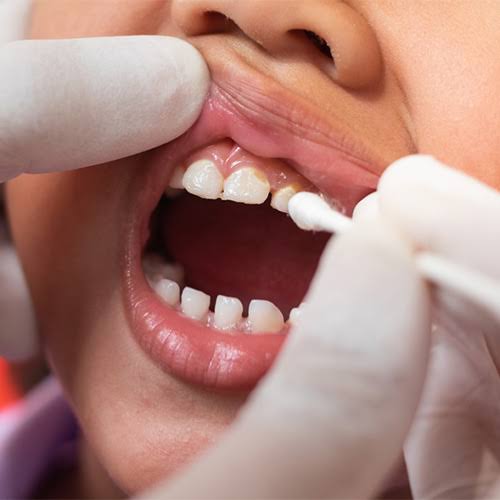 Fluoride Treatments