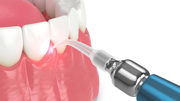 Laser periodontal pocket layout tissue micro decontamination clinical view photo