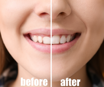 Aesthetic micro-calibrated gingival soft laser gummy smile reduction action view photo