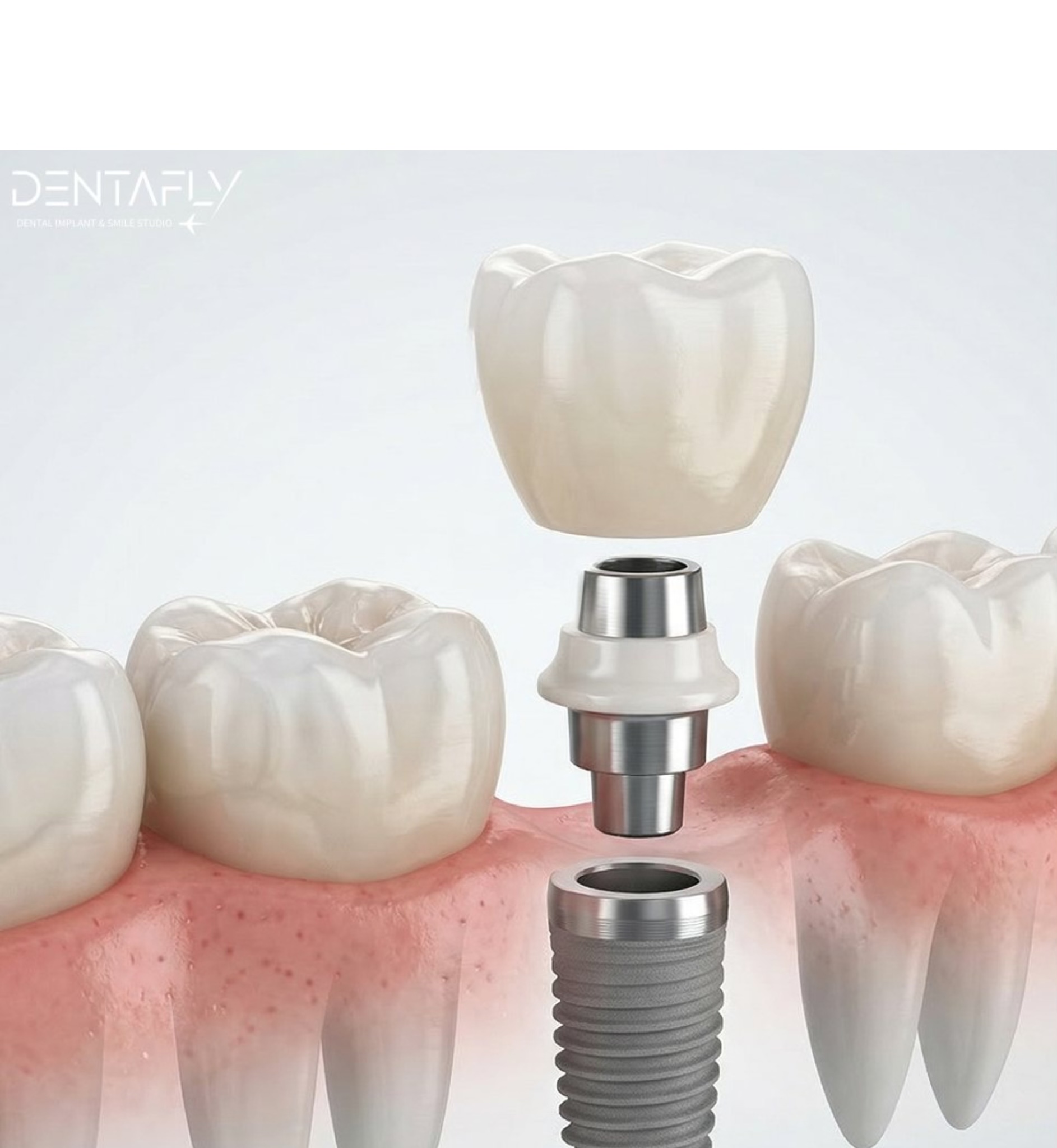Single Dental Implant micro Placement architectural Mapping structure diagram