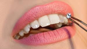 Clinical application of tooth jewellery