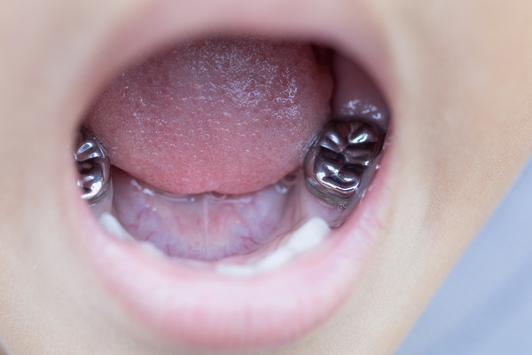 Pediatric Crowns