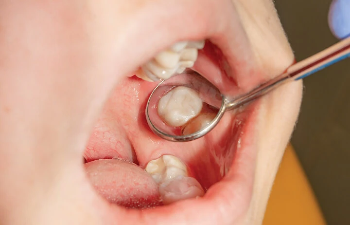 Dental Cleaning