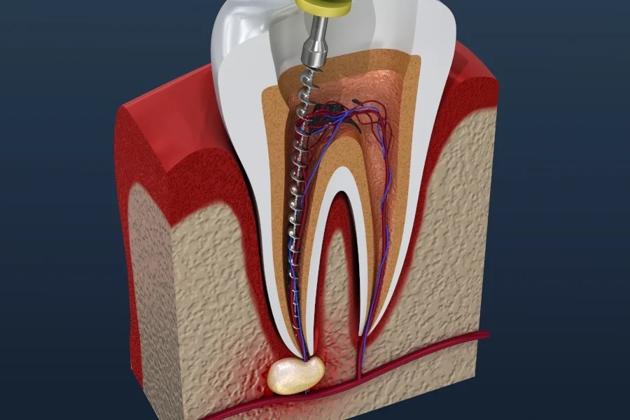 Endodontic canal laser micro sterilization deep reach clean pathway action photo