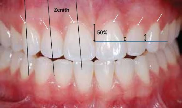 Cosmetic smile leveling dental alignment gingival frame balancing photo