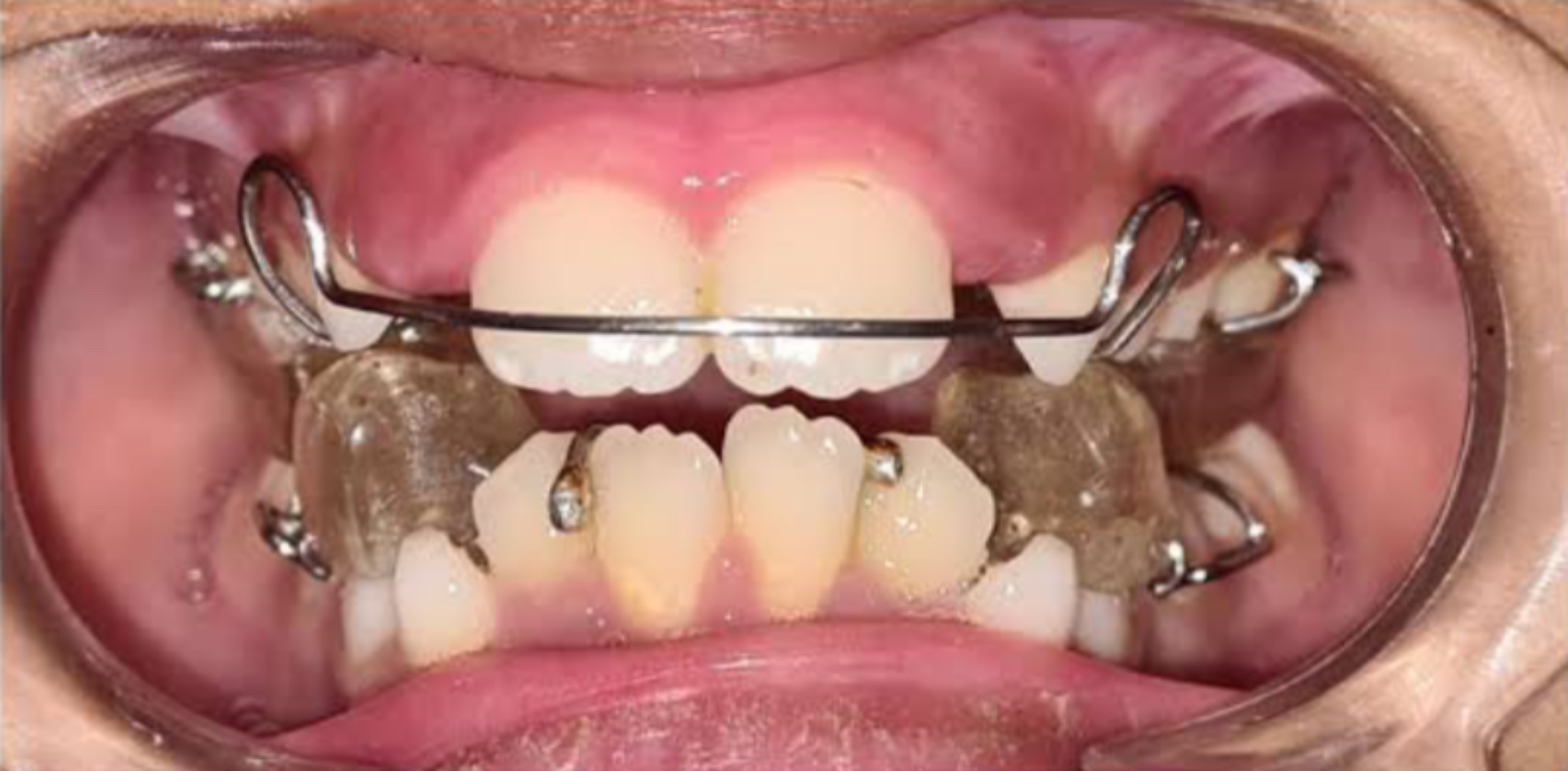 Myofunctional Treatments