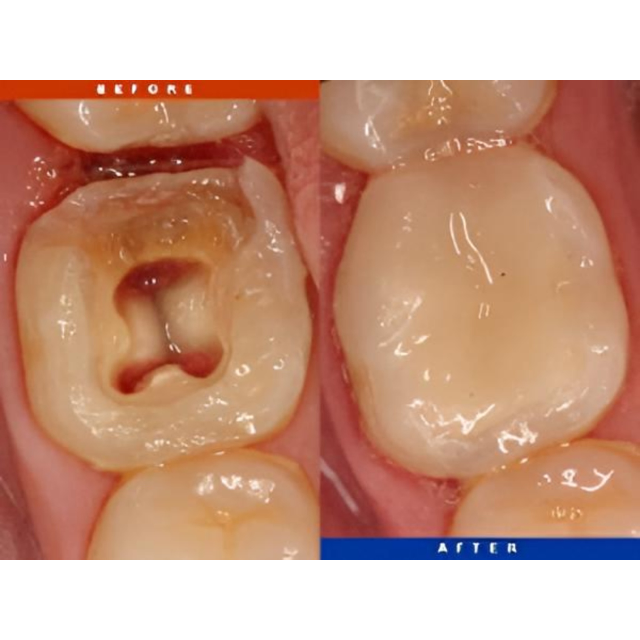 Pulpotomy Root Care