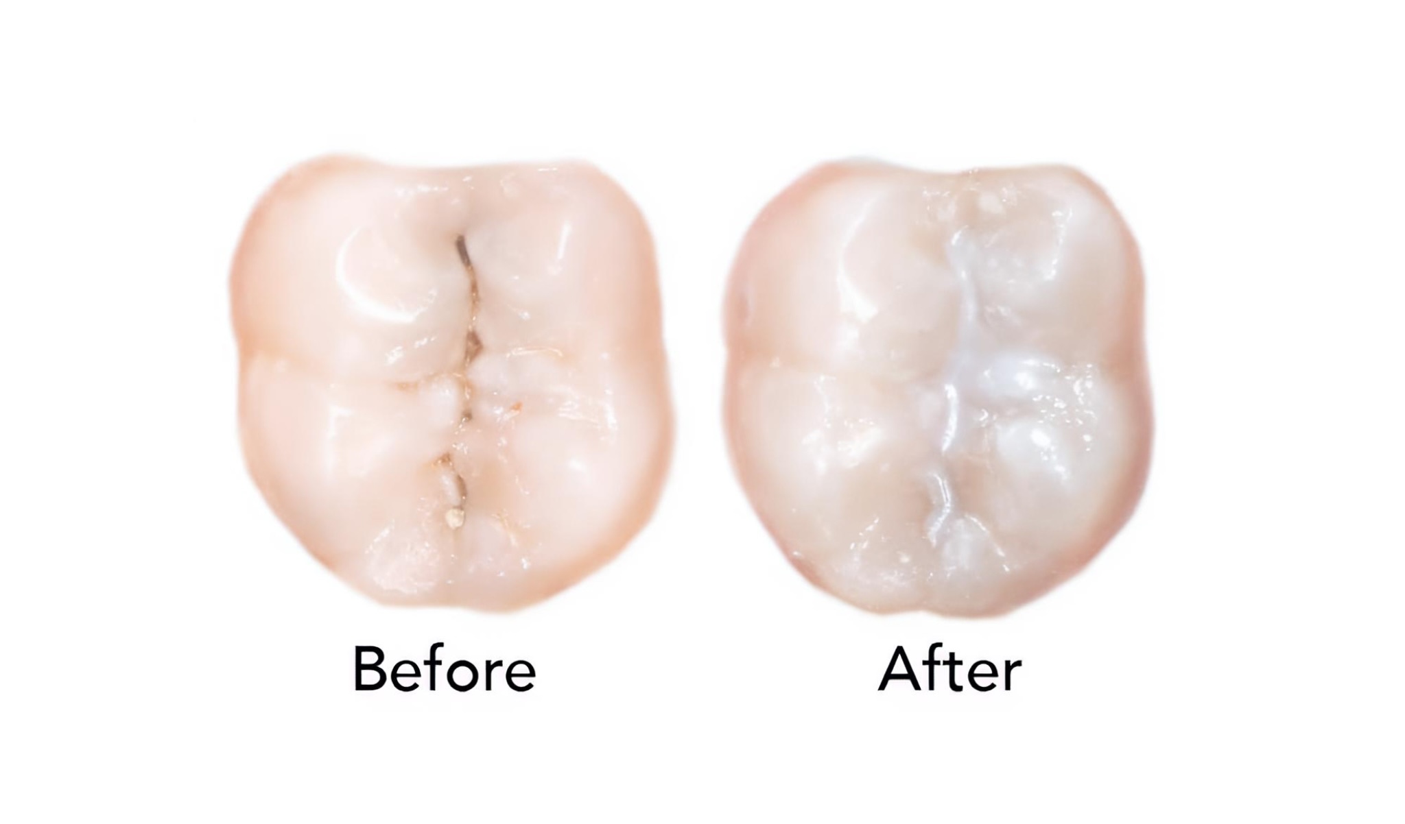 Dental Sealants