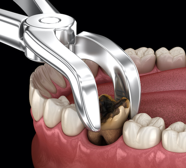 Routine erupted therapeutic extraction dental post-care recovery consultation view