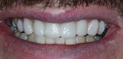 Final aesthetic smile trial integration