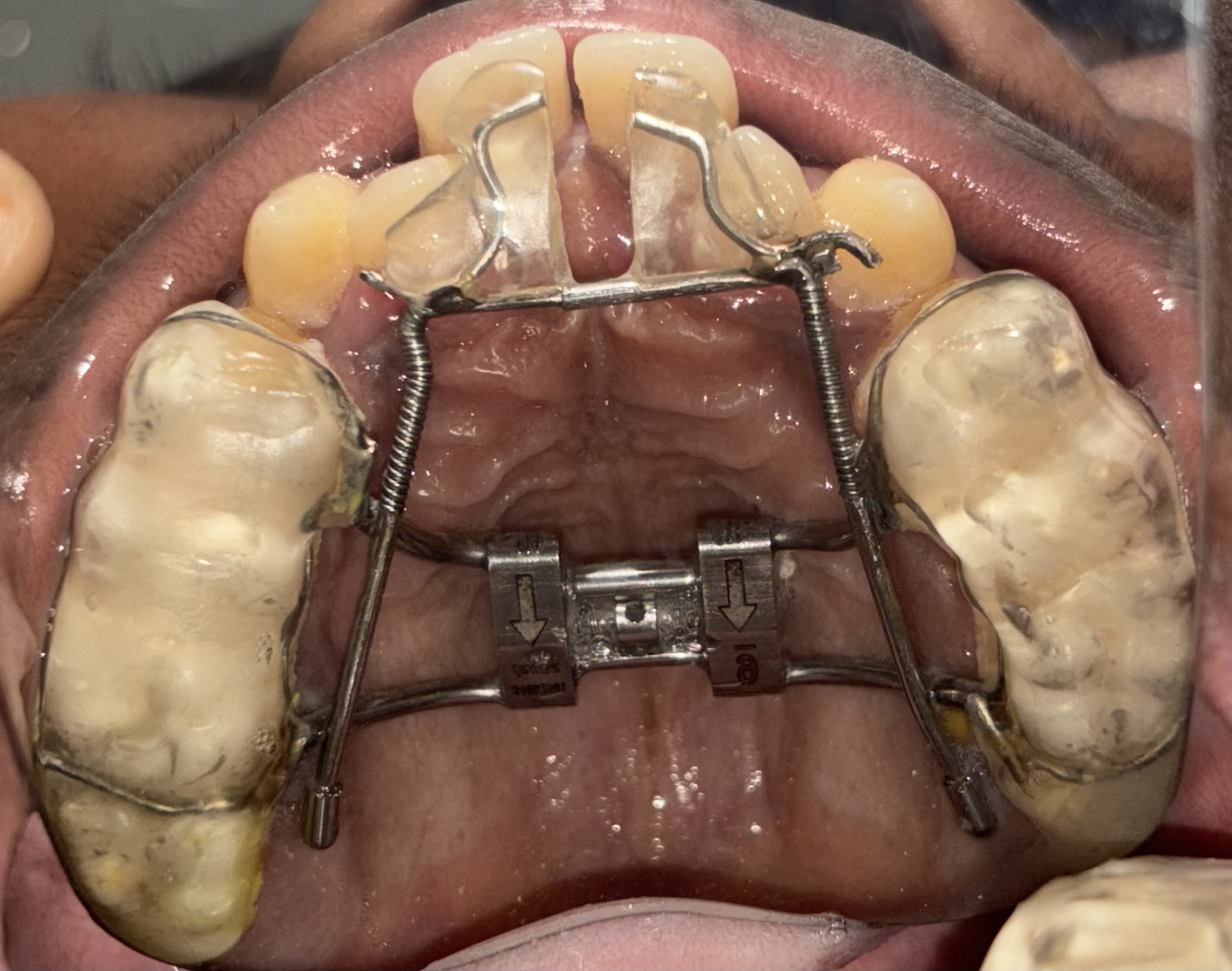 Dental Cleaning