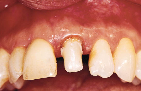 Restorative fiber-reinforced baseline core buildup and custom dental crown prep configuration view