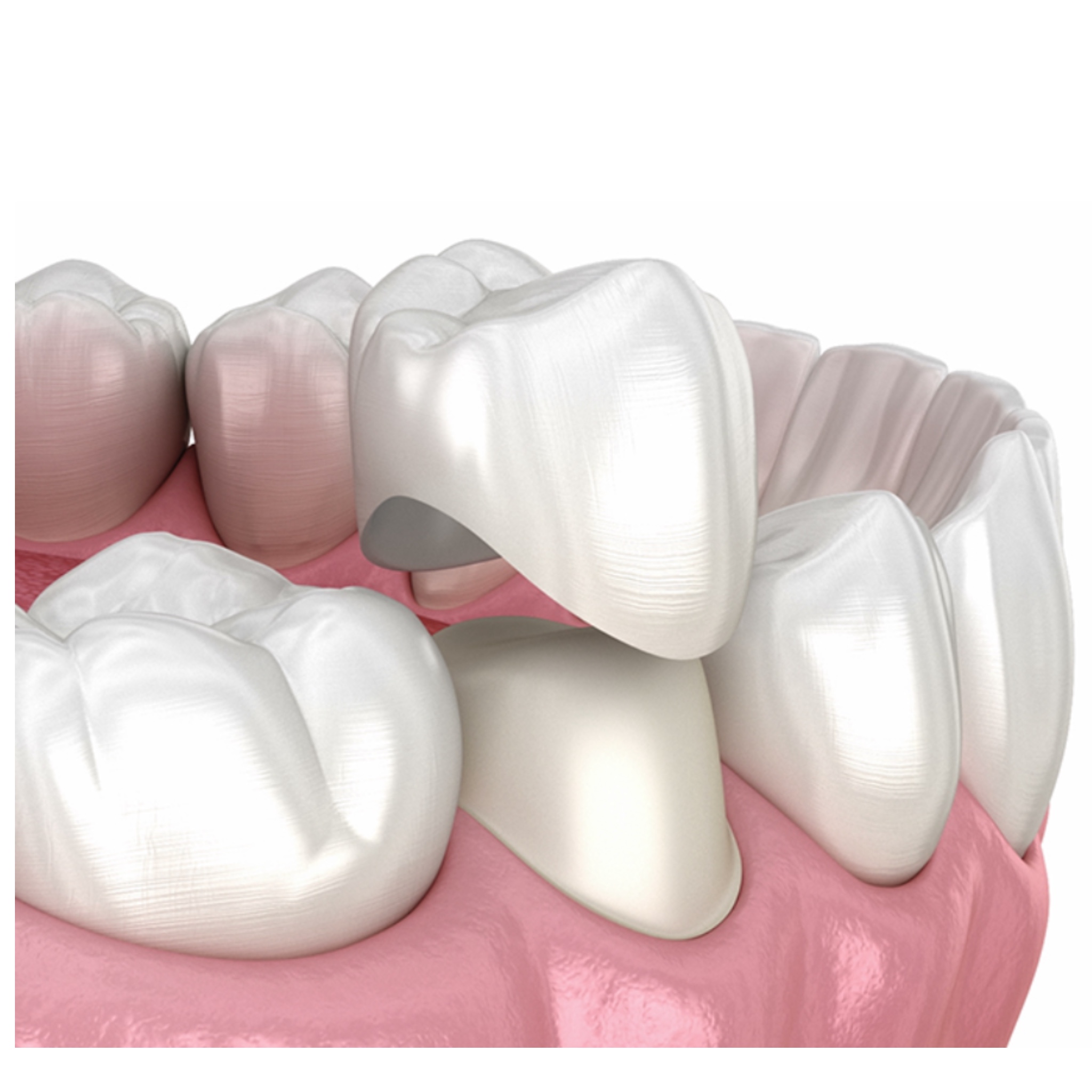 Solid computer milled translucent full Zirconia protective crown restoration macro photo